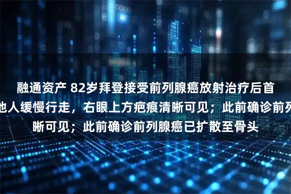 融通资产 82岁拜登接受前列腺癌放射治疗后首次公开露面，扶着他人缓慢行走，右眼上方疤痕清晰可见；此前确诊前列腺癌已扩散至骨头